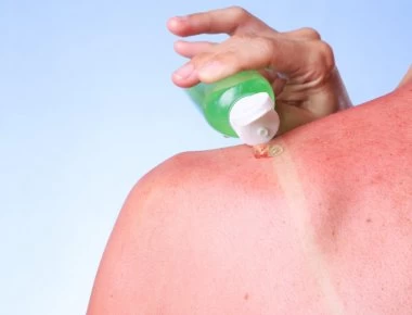 Έγκαυμα από τον ήλιο: Αντιμετωπίστε το σε 5 βήματα